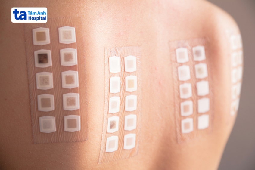 test 18 dị nguyên giúp xác định dị ứng gây viêm da