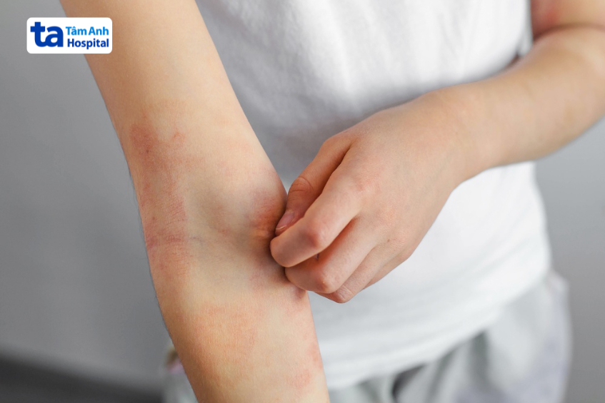 test dị nguyên cho người viêm da tái phát, dễ dị ứng