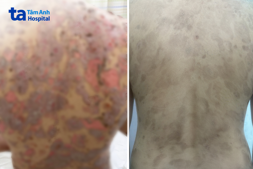 tình trạng bóng nước, lở loét da của anh phú đã được kiểm soát sau 2 tháng điều trị