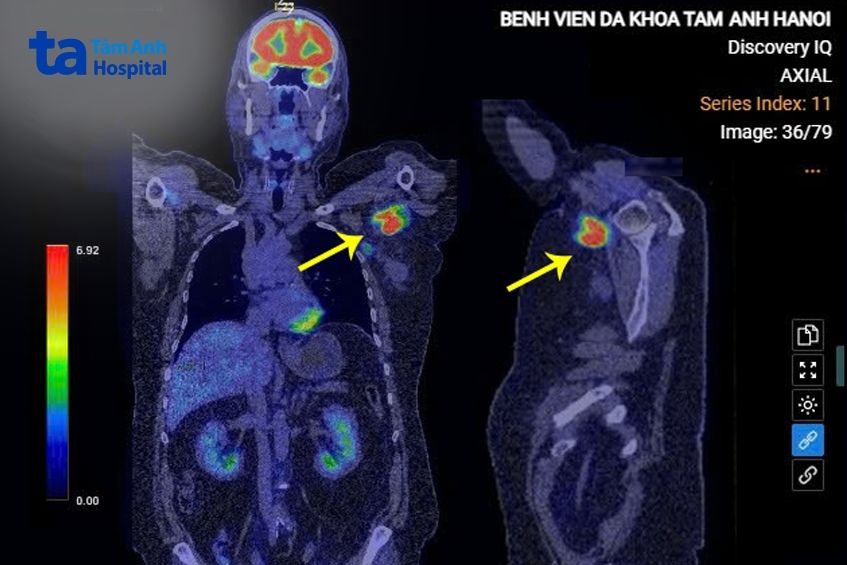 tổ chức u lympho lớn tại hố nách trái người bệnh