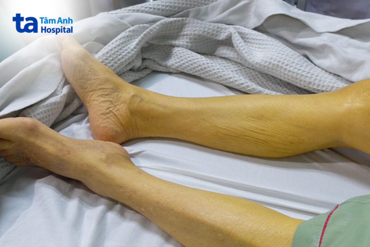 triệu chứng đồng nhiễm viêm gan B và D