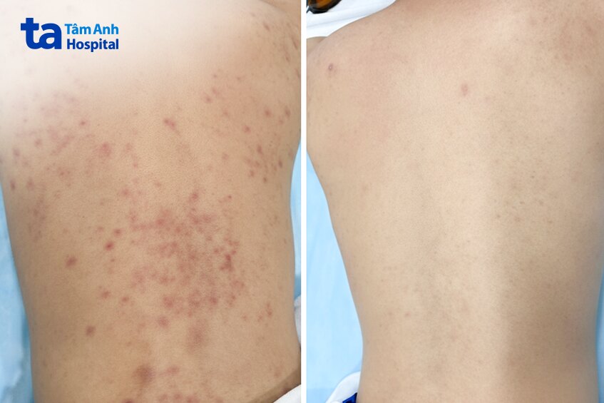 trước và sau khi điều trị