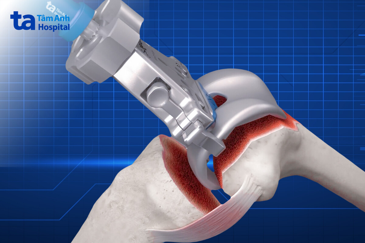 tương thích nhiều loại khớp nhân tạo