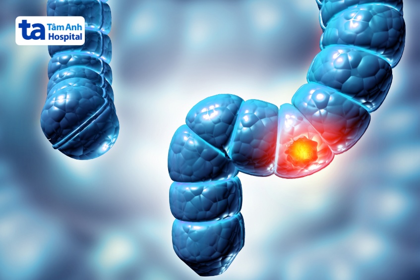 ung thư đại trực tràng gây LBO