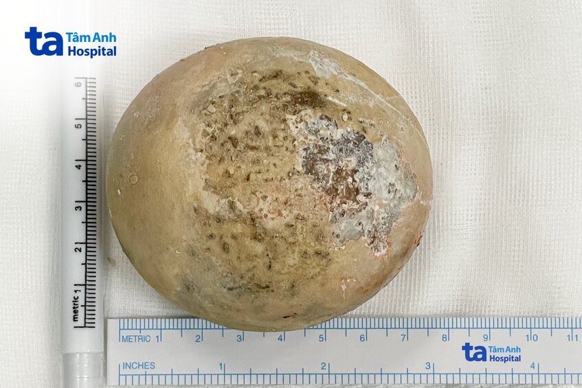 viên sỏi bằng nắm tay