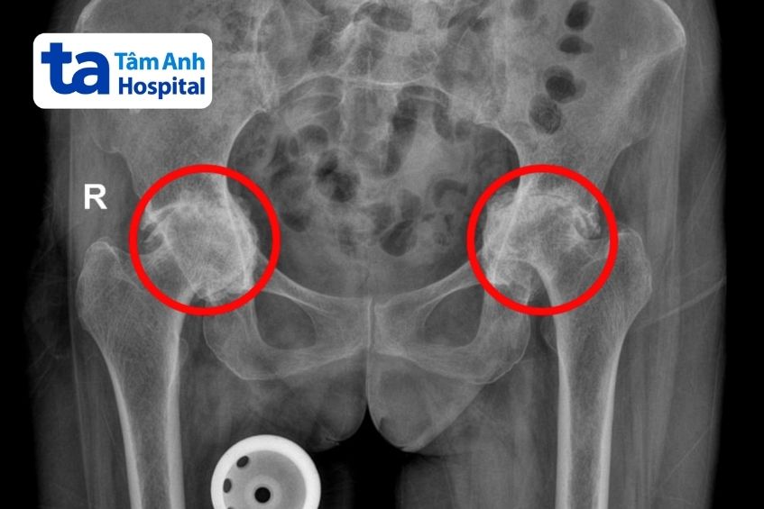 x quang thấy khớp háng dần chui vào ổ bụng