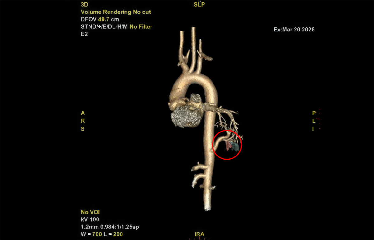 Ảnh chụp CT dựng hình 3D động mạch chủ của bệnh nhân cho thấy một nhánh động mạch bất thường (khoanh đỏ)
