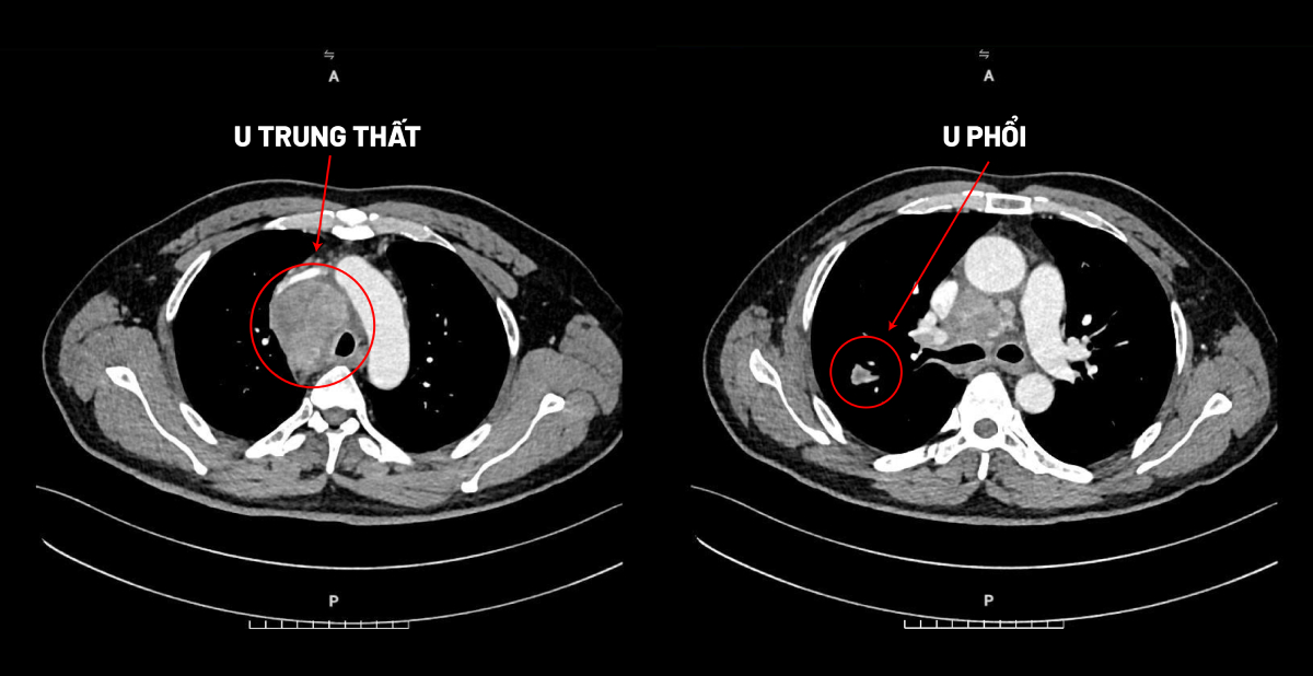 Ảnh chụp CT cho thấy người bệnh cùng lúc có hai khối u trong lồng ngực