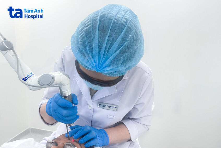 bác sĩ dùng laser pico xoá xăm cho khách hàng