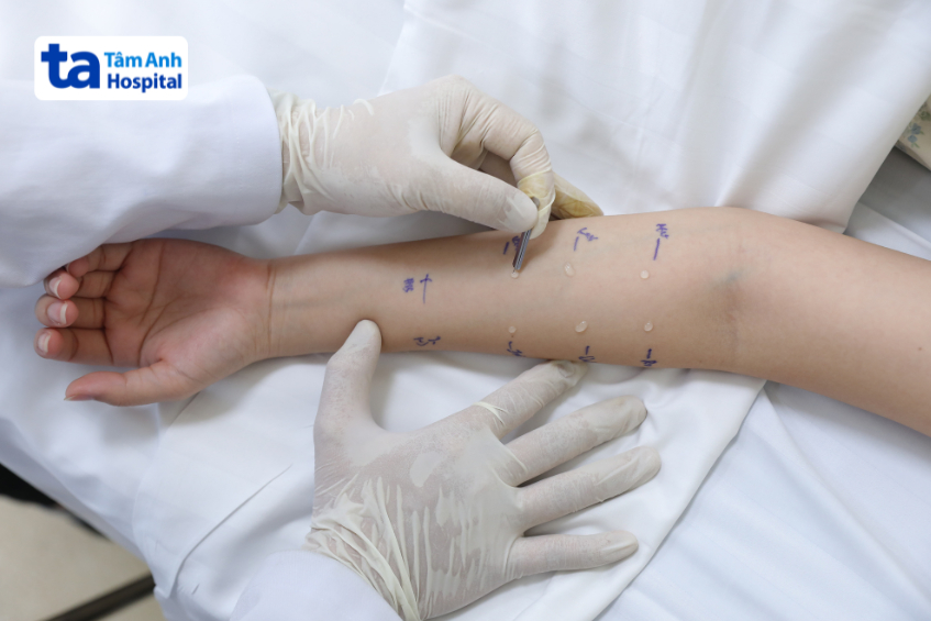 bác sĩ khoa miễn dịch lâm sàng đang thực hiện test lẩy da cho khách hàng