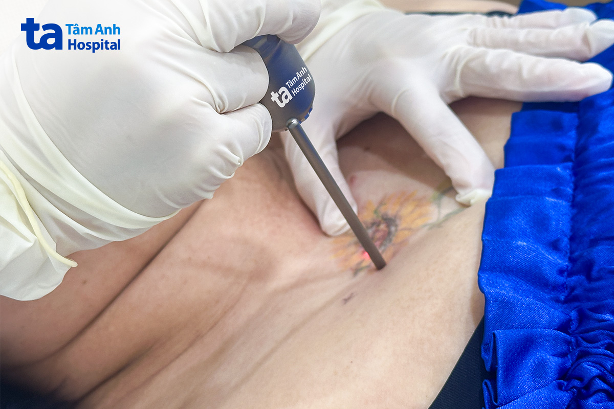 bác sĩ thực hiện xóa xăm bằng laser pico