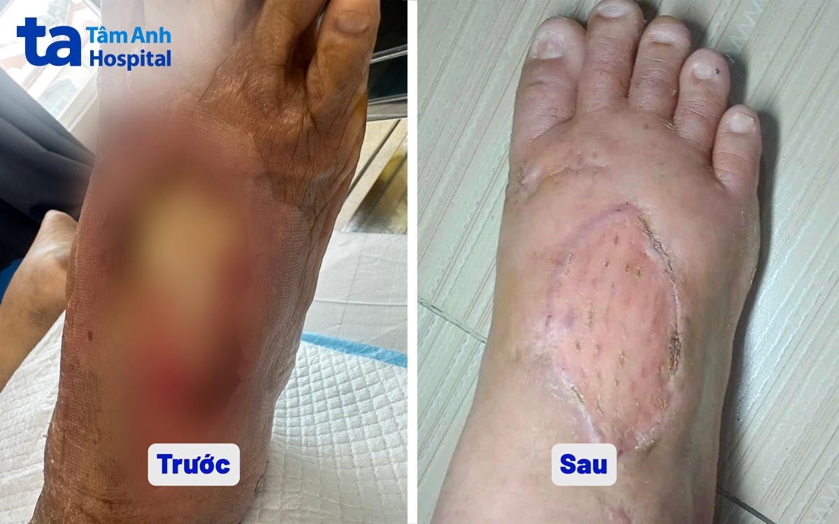 bàn chân của ông chanvatey trước và sau khi điều trị