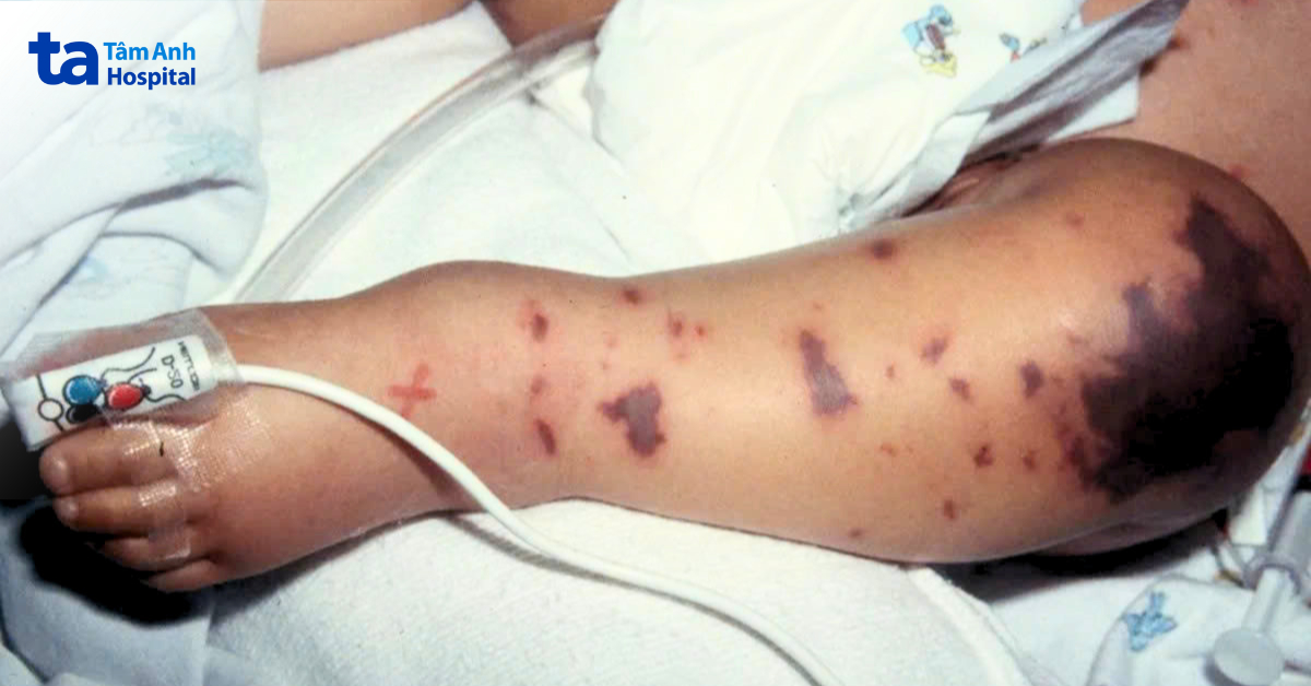 Ban tím – Dấu hiệu cảnh báo não mô cầu chuyển nặng