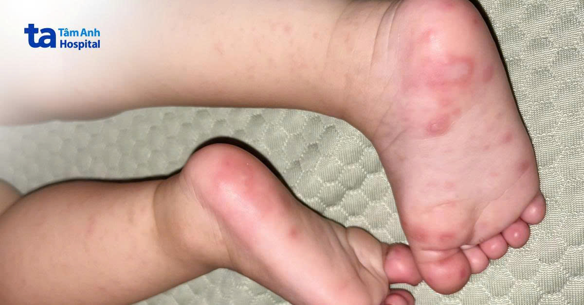 bệnh nhi có các triệu chứng điển hình của chân tay miệng.