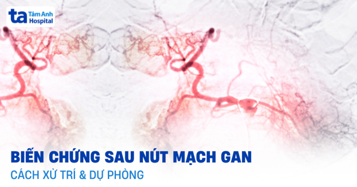 Các biến chứng sau nút mạch gan cần xử lý thế nào?