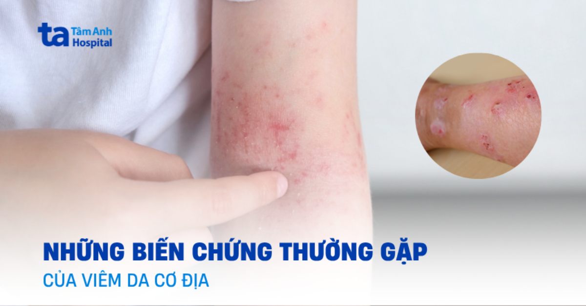 Cẩn trọng với biến chứng viêm da cơ địa thường gặp