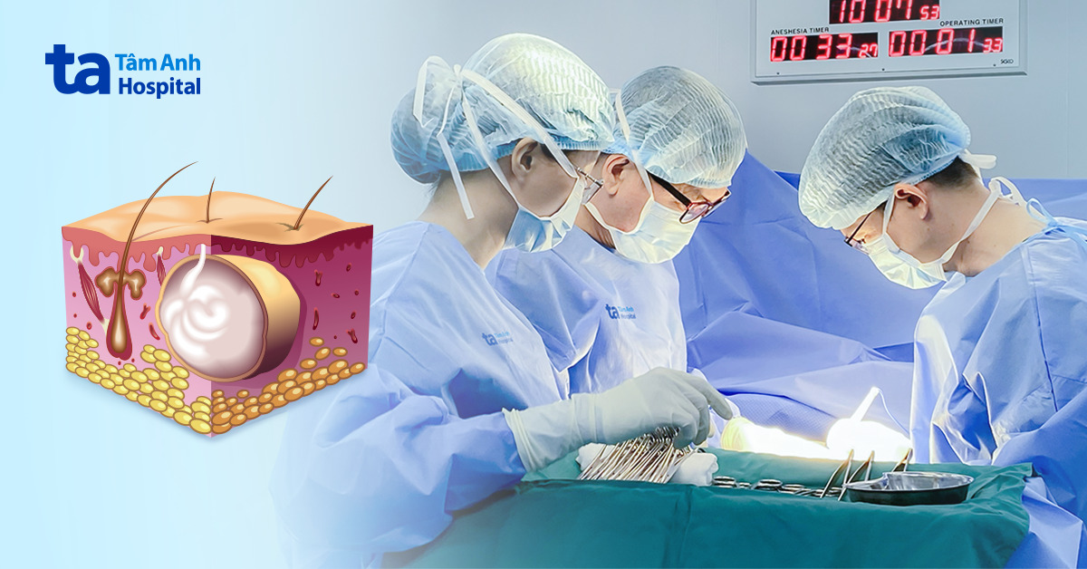 Bướu bã đậu 10 năm hóa ác tính