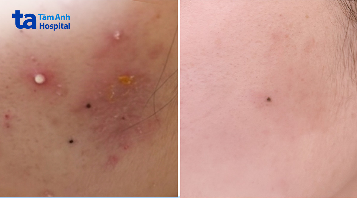 cải thiện da sau 1 tháng điều trị
