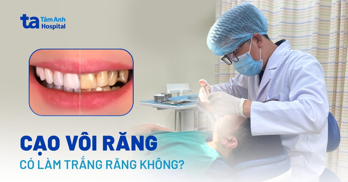Cạo vôi răng có làm trắng răng không và hiệu quả đến đâu?