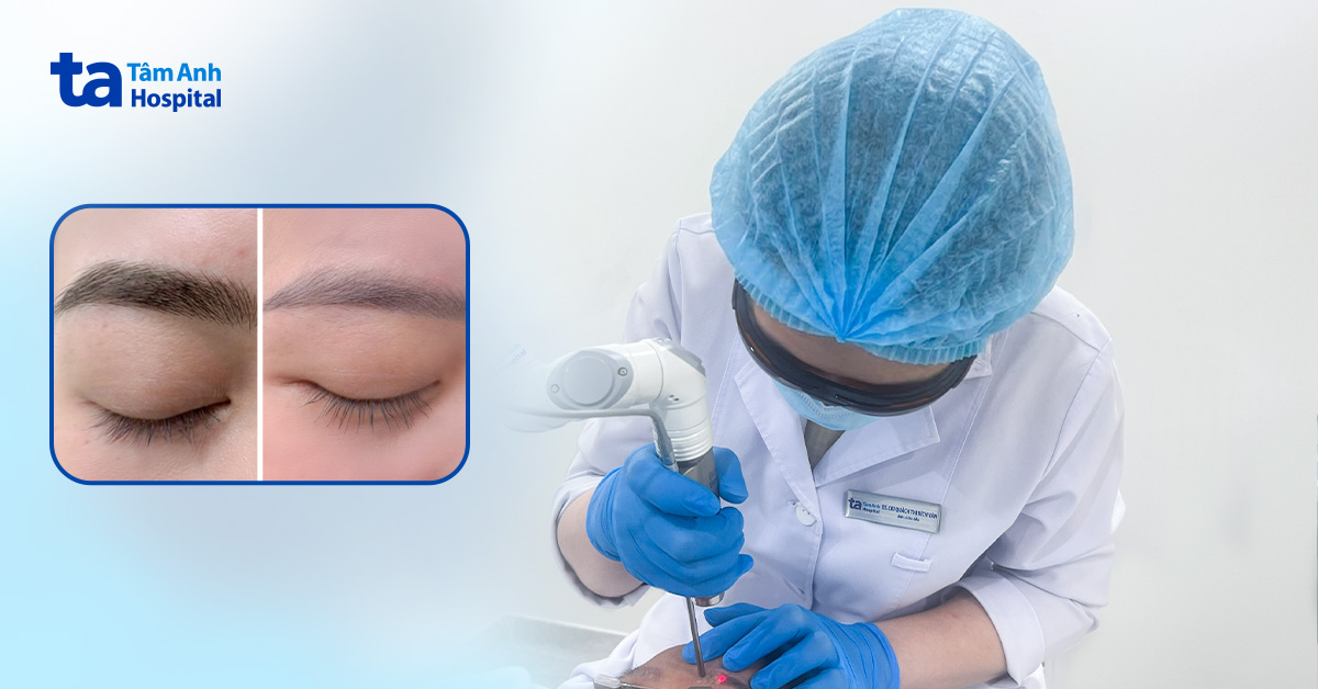 Chật vật xóa xăm chân mày bị hỏng