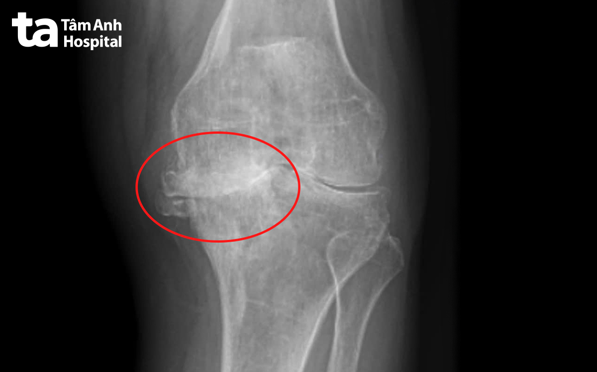 chụp xquang thấy tổn thương nghiêm trọng