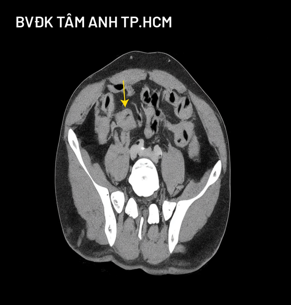 CT thấy khối u ở gan