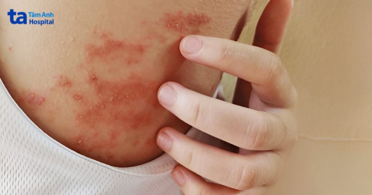 da bị ngứa đỏ rát