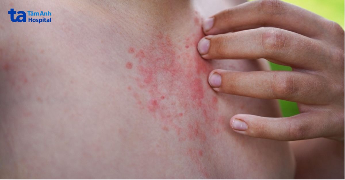 da bị nổi mẩn ngứa ở vùng cổ