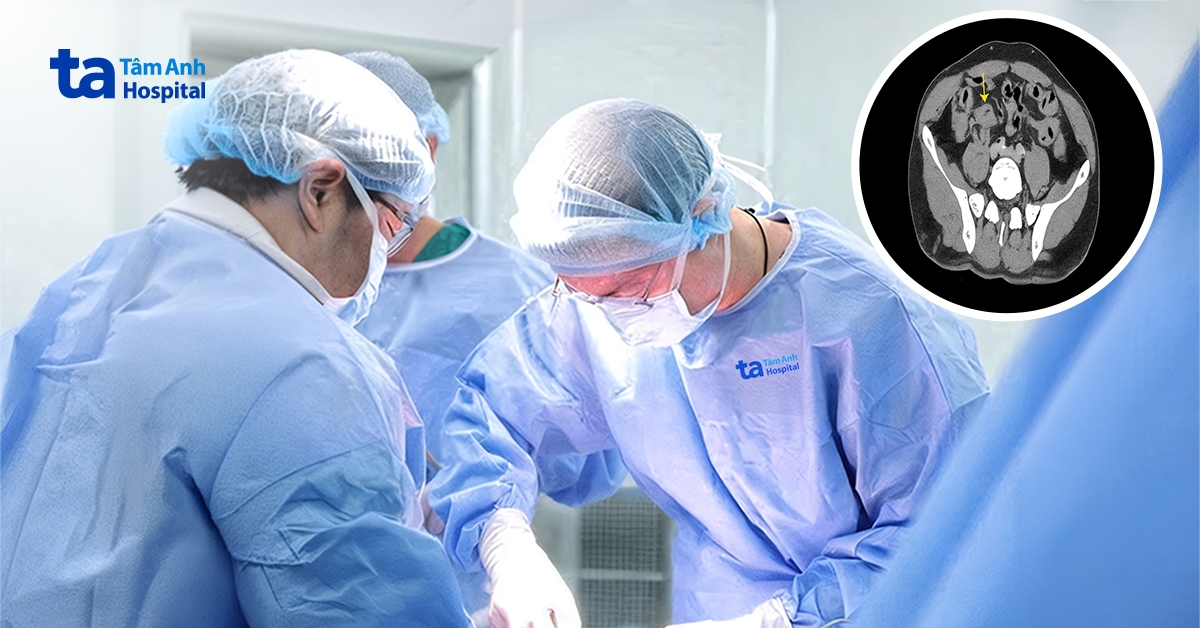 Đau bụng kéo dài, phát hiện ung thư đại tràng di căn