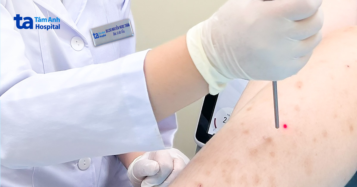 Ứng dụng laser điều trị biến chứng viêm da sau tẩy lông