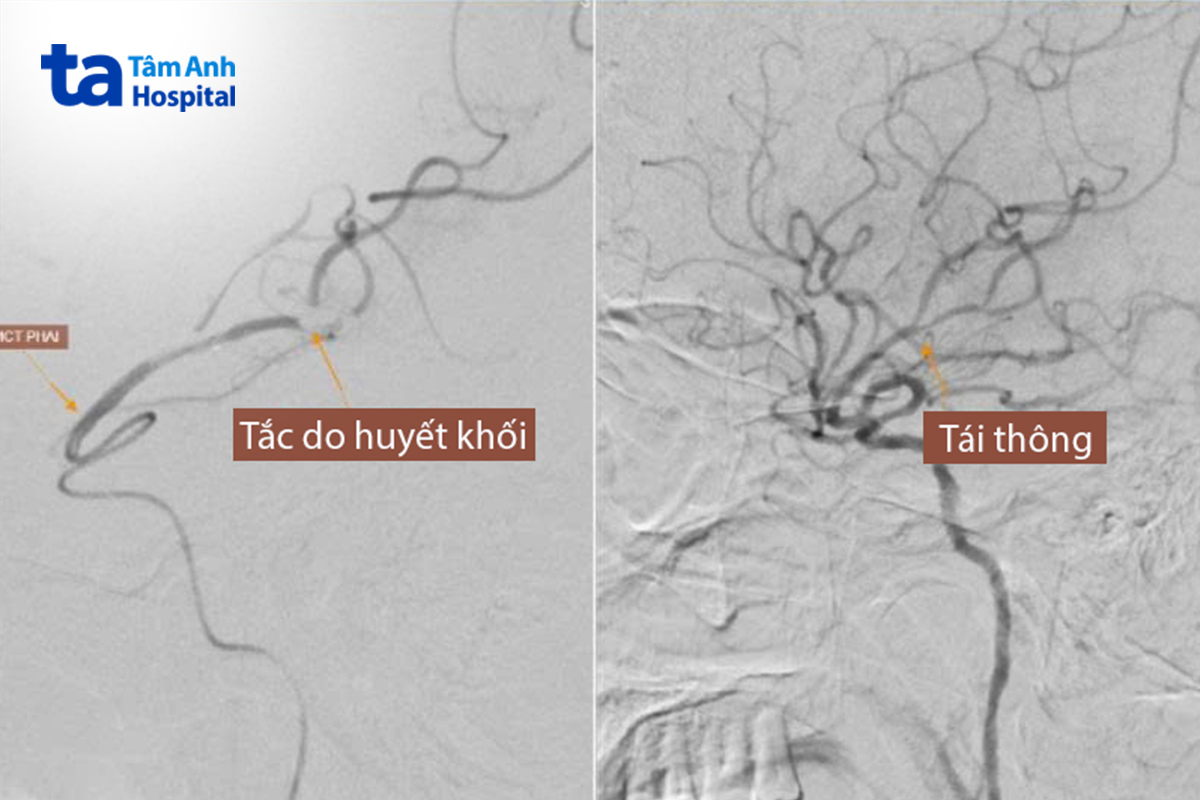động mạch não bị tắc