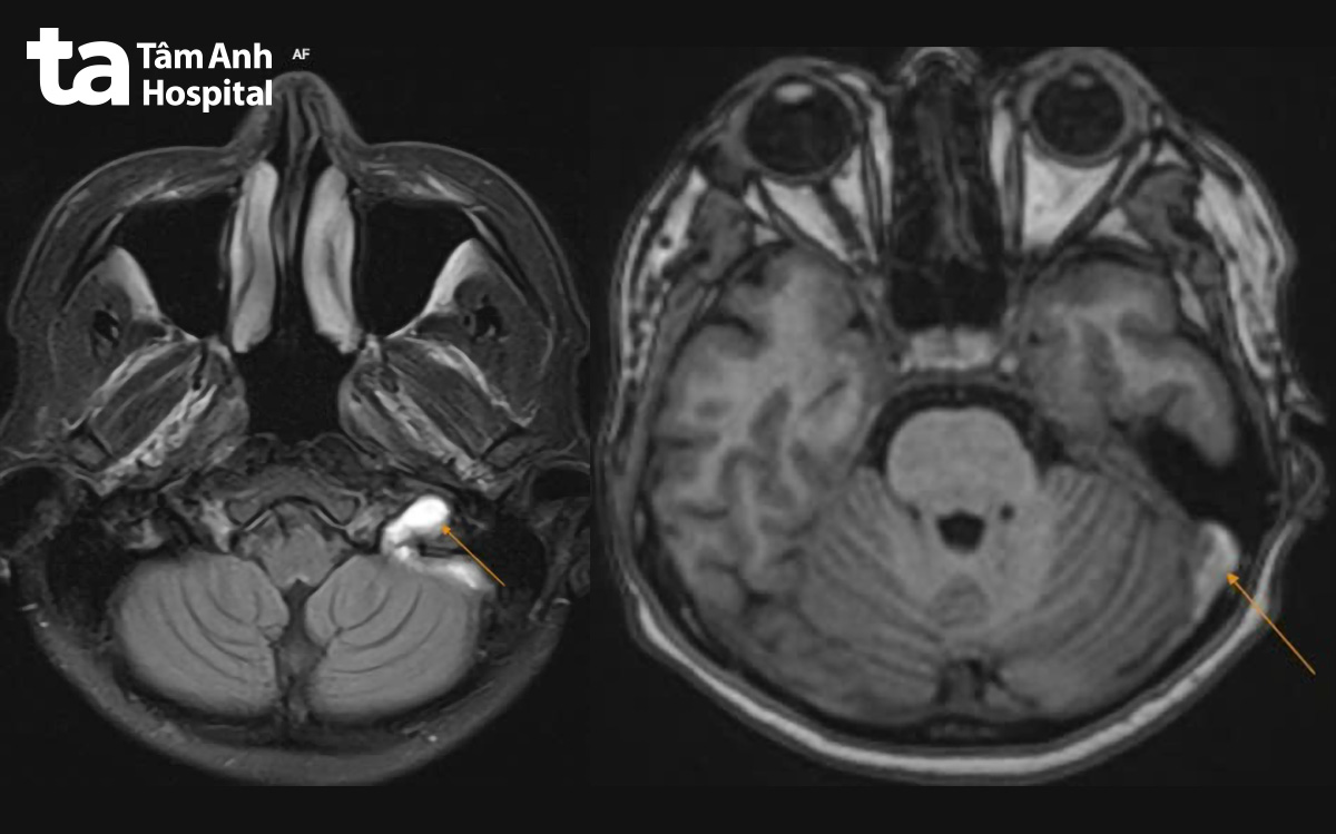 hình ảnh mri đau đầu