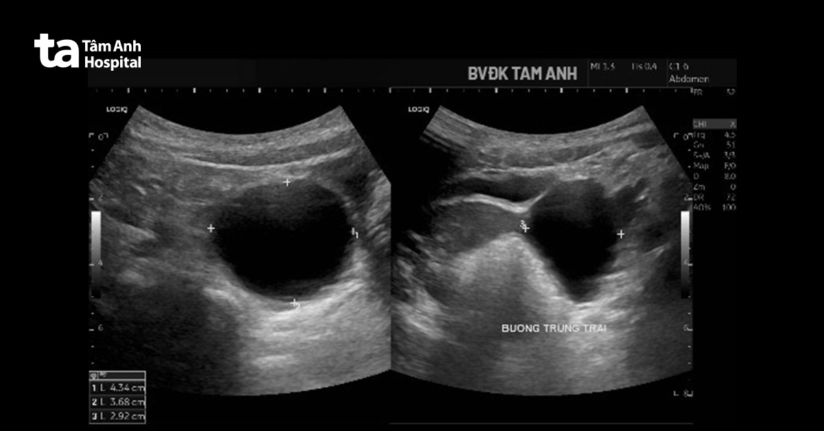 hình ảnh nang buồng trứng phì đại trên siêu âm của bé huyền