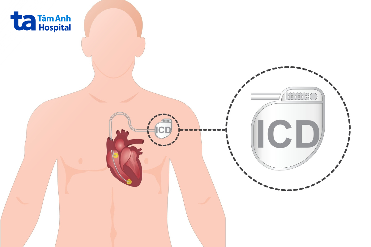 hình ảnh thiết bị khử rung tim cấy ghép (ICD) giúp theo dõi liên tục hoạt động điện học của tim