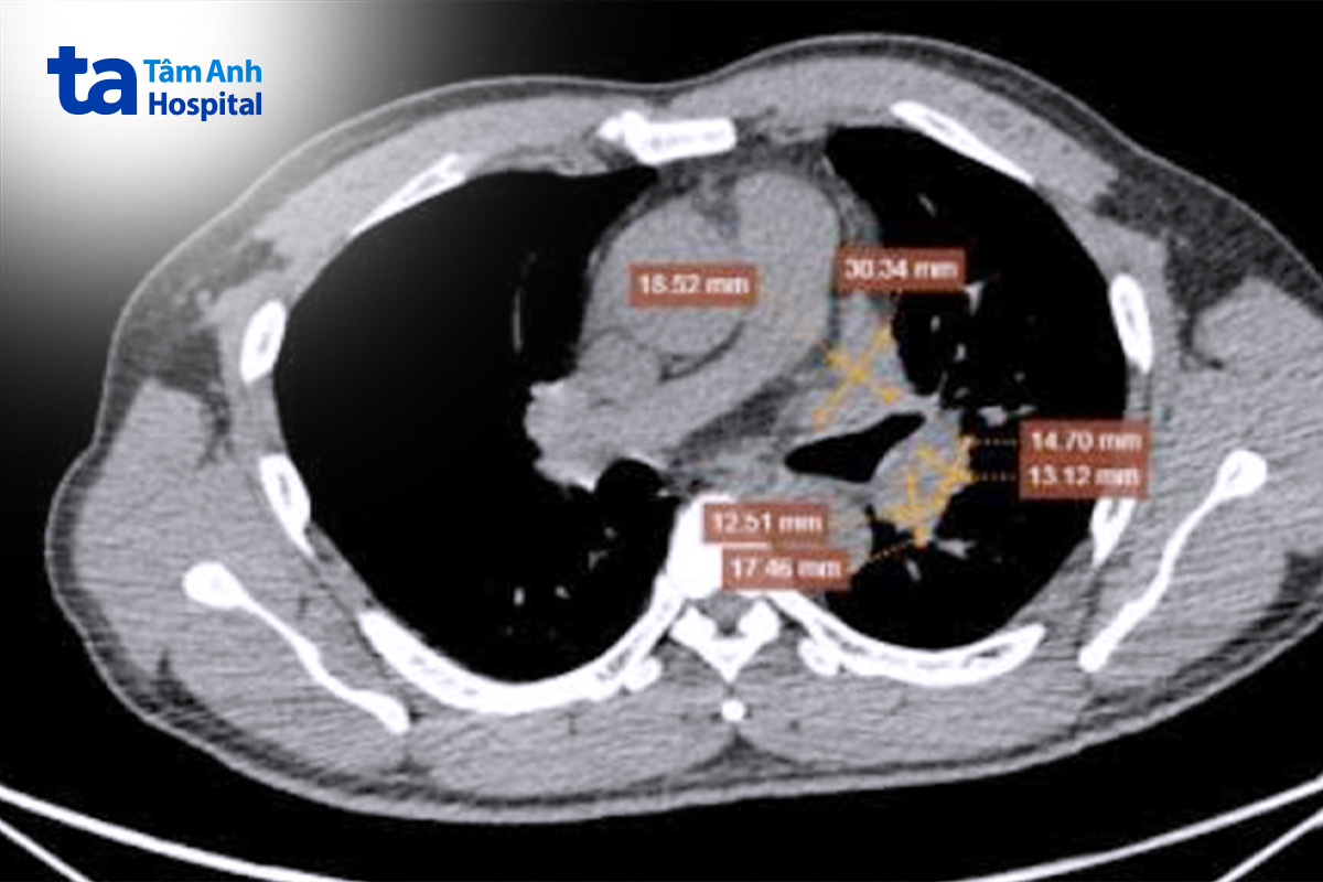 khối u ác tính xâm lấn