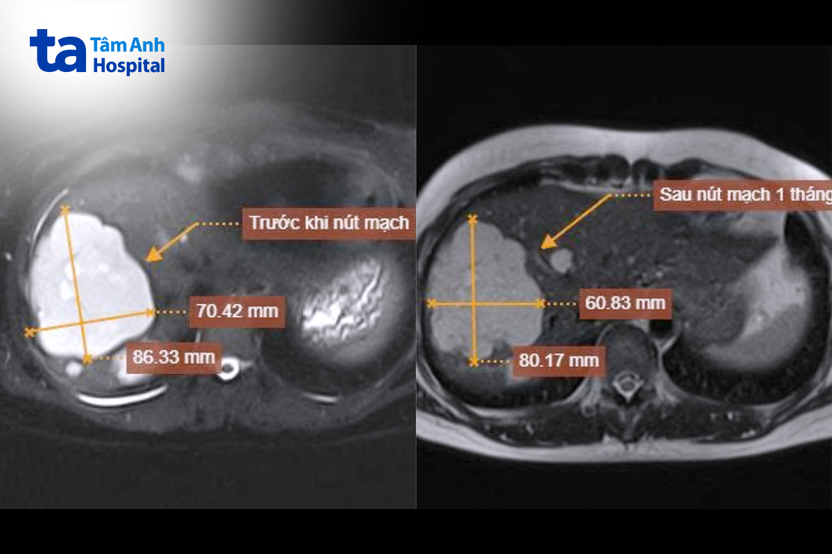 khối u giảm kích thước