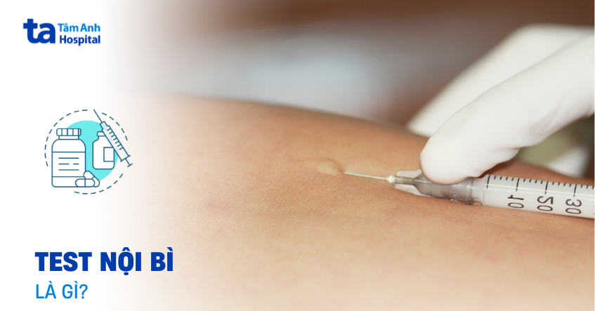 Kỹ thuật test nội bì: Khi nào được chỉ định thực hiện?