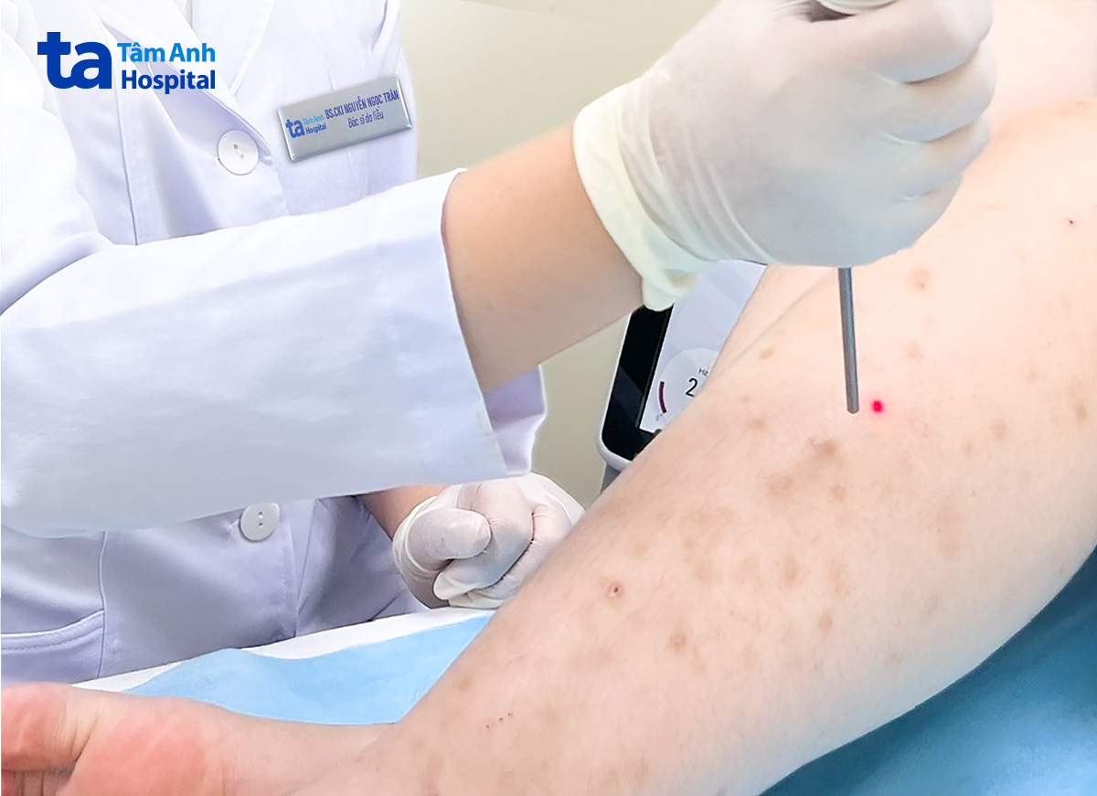 Cận cảnh điều trị tăng sắc tố sau viêm nang lông bằng laser pico giúp làm mờ thâm và phục hồi da