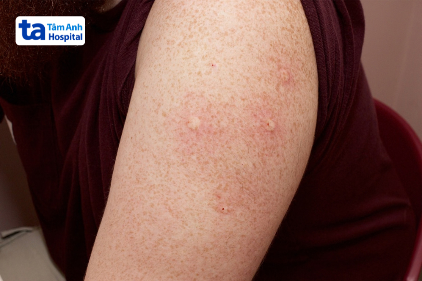 minh họa test nội bì âm tính, vị trí tiêm không xuất hiện sẩn phù đáng kể