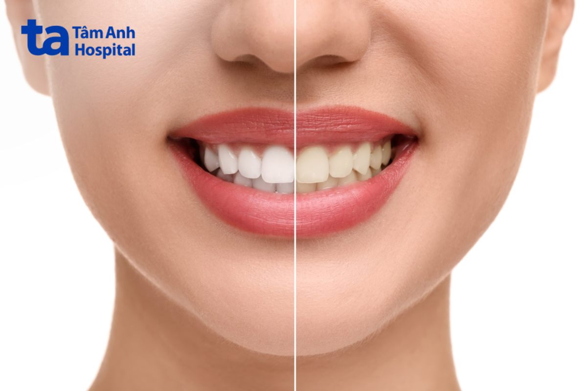 hình ảnh mình họa răng trắng và răng vàng 