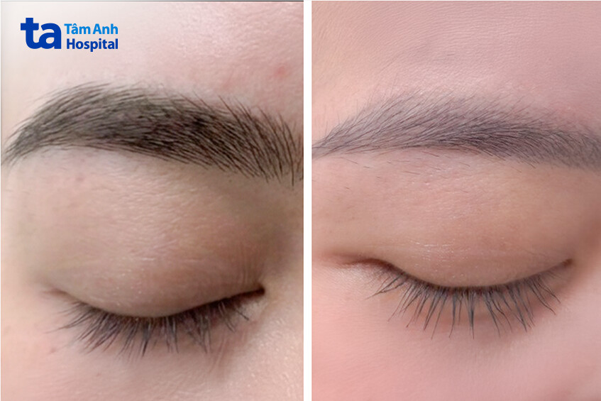 mực xăm đã nhạt hơn sau 3 lần laser