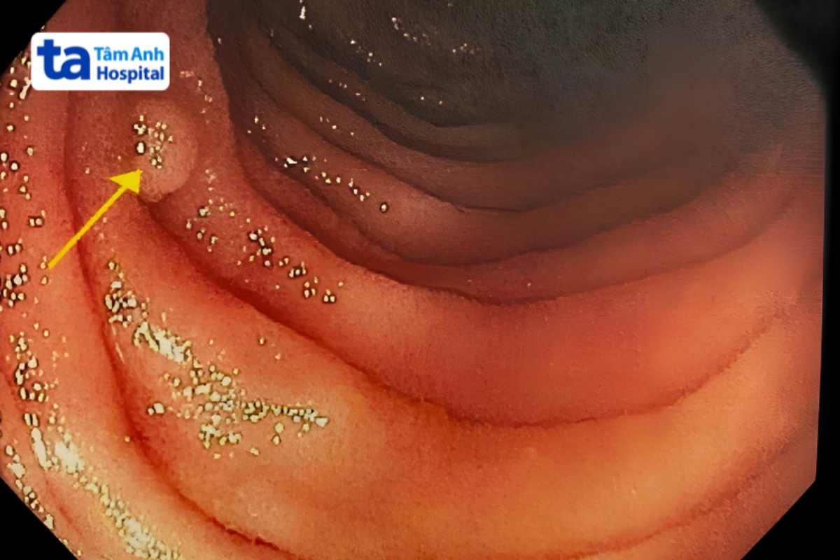 polyp nhô ra từ niêm mạc