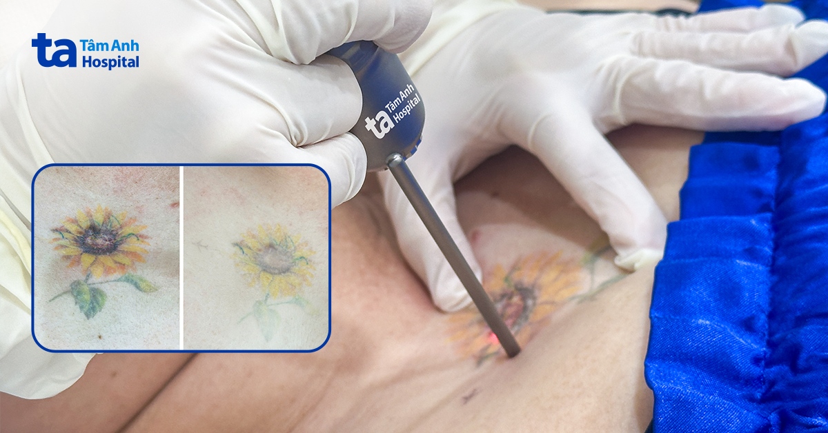 Sai lầm khi xăm hình che sẹo lồi