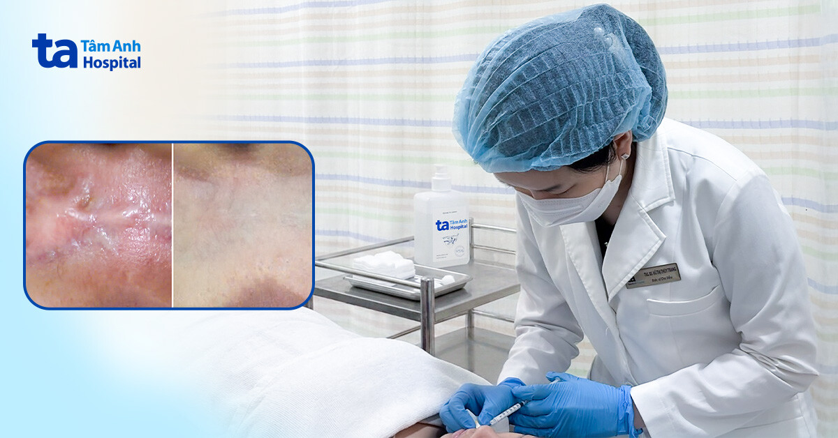 Sẹo lồi môi lan gấp đôi sau tai nạn giao thông