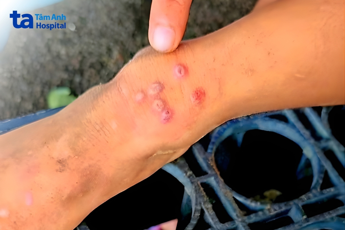 “Sốt đất” là bệnh nguy hiểm do có thể lan nhanh và gây tổn thương nhiều cơ quan như da, phổi, gan...