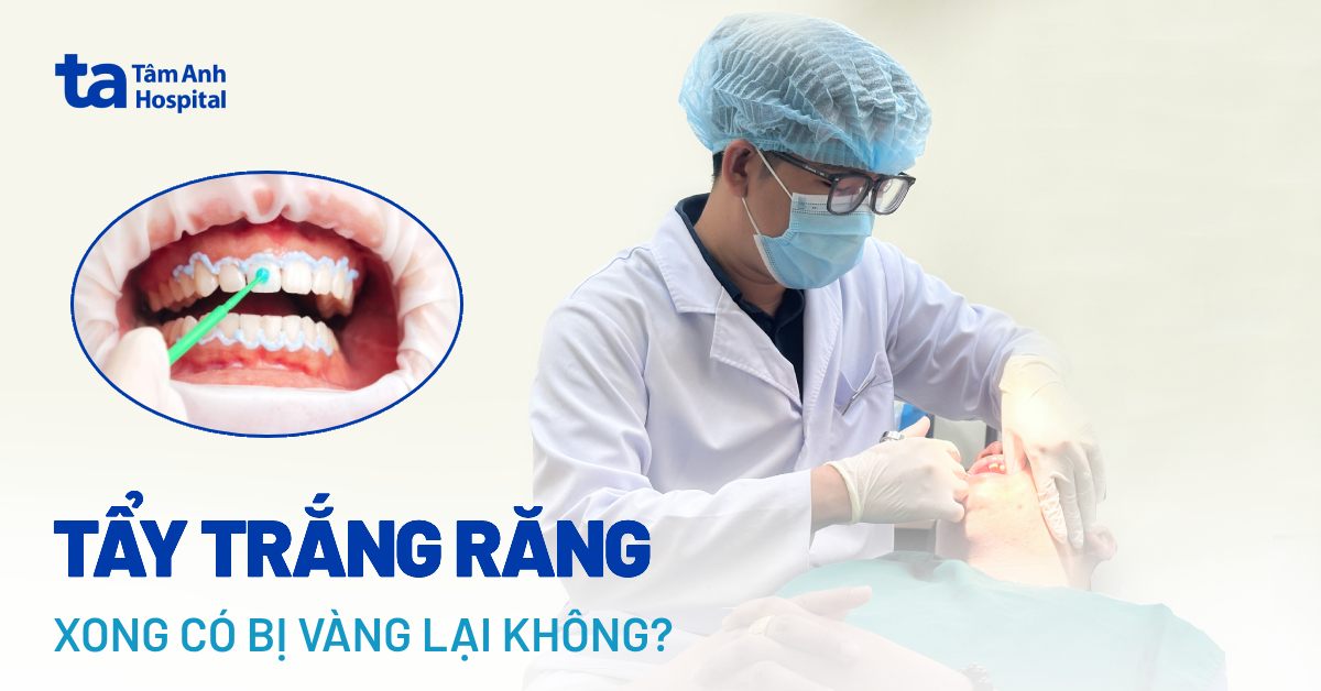 Tẩy trắng răng xong bị vàng lại không? Do đâu và cách xử lý