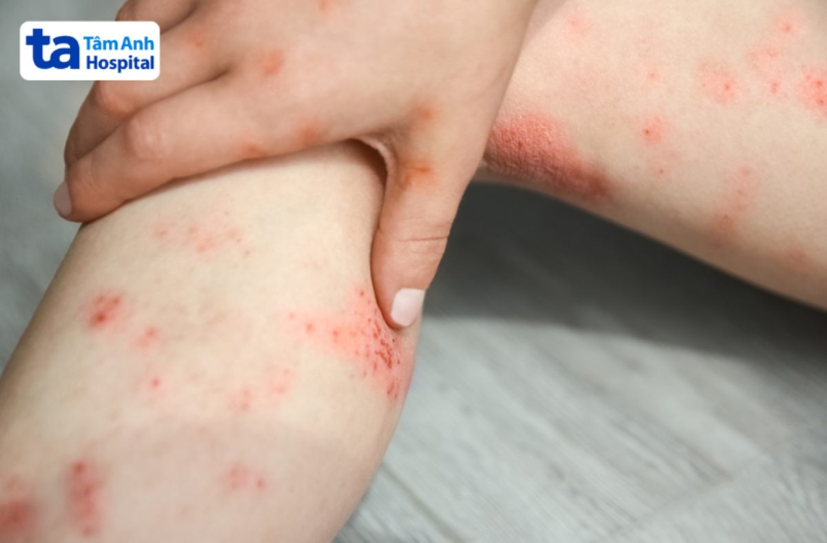trẻ gãi khiến vùng da bị xước rát