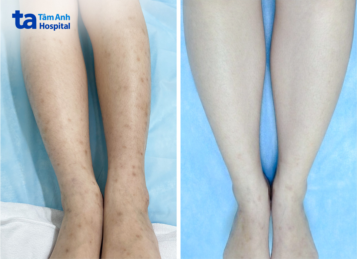 Hình ảnh trước và sau điều trị thâm do viêm nang lông bằng laser pico cải thiện rõ sắc tố da