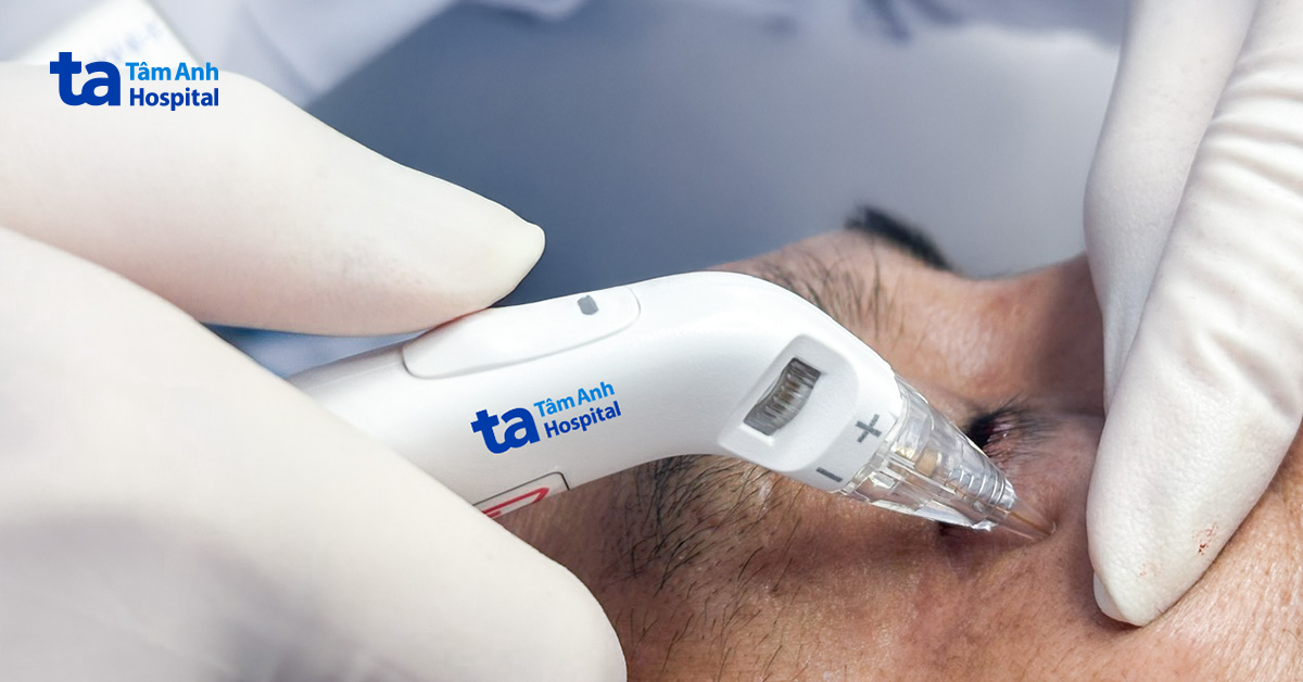 Tự ti vì bọng mắt lớn