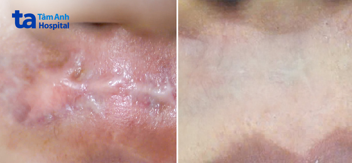 vết sẹo lồi đã phẳng đáng kể